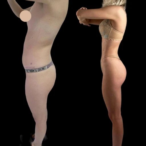 Rib Removale Before and After Images in Dubai - Perfect Doctors Clinic | Aesthetic & Plastic Surgery Clinic in Dubai